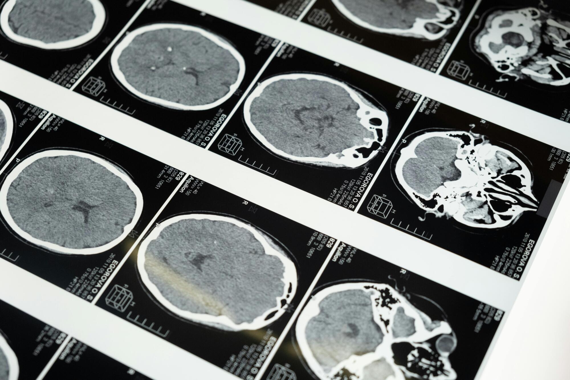 Celebrities with brain tumors who inspired millions with their courage